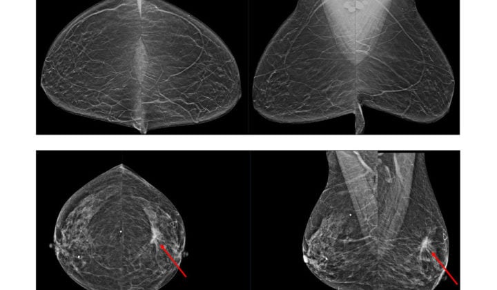 AI-assisted breast cancer screening could reduce unnecessary testing